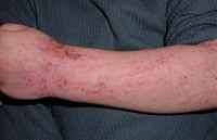 Arm mit Neurodermitis