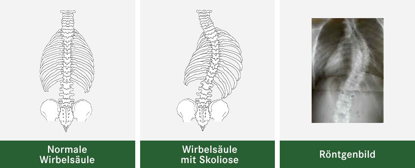 Eine normale Wirbelsäule im Vergleich mit einer Wirbelsäule mit Skoliose