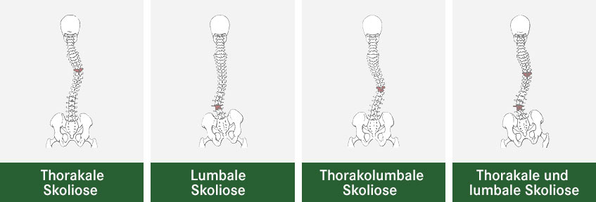 Thorakale, Lumbale, Thorakolumbale Skoliose